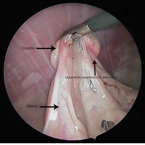 Esterilització per laparoscòpia